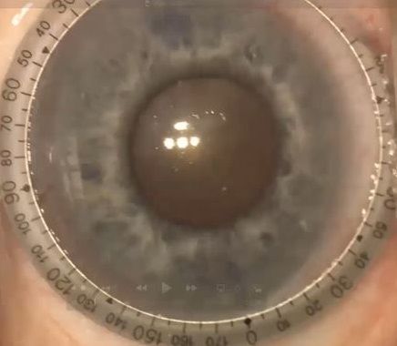 Complex and Dense Cataract